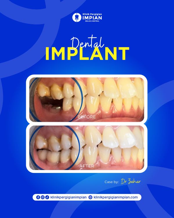 implant-1