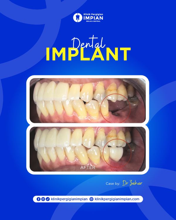 implant-2