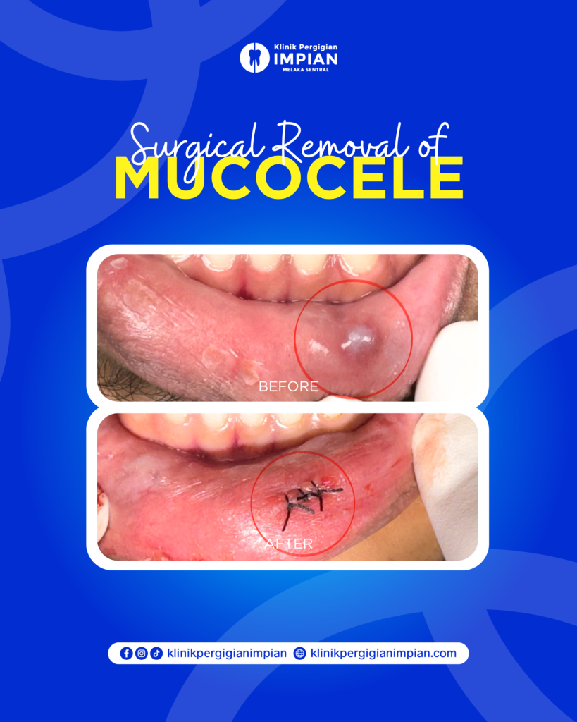 Mucocele