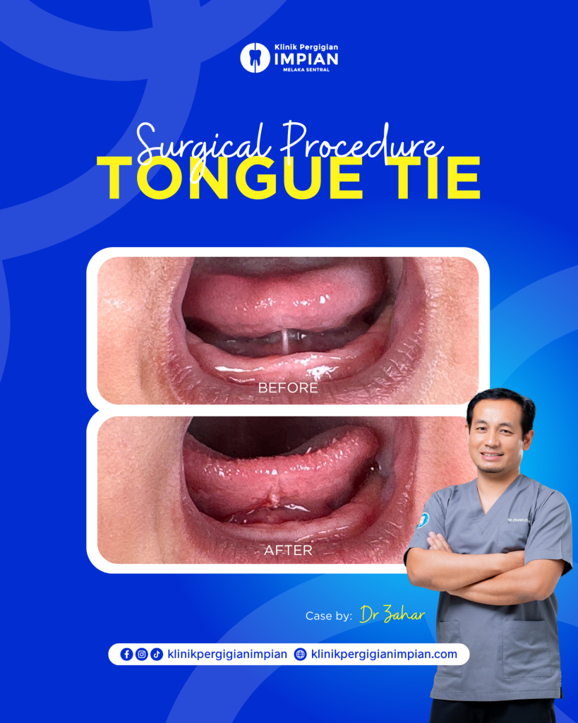 Tongue tie